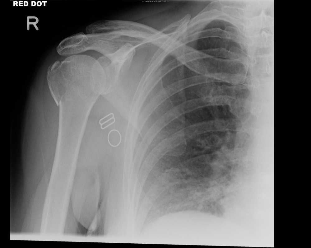 icd 10 left shoulder greater tuberosity fracture